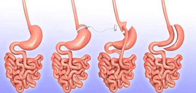 عملية ربط المعدة
